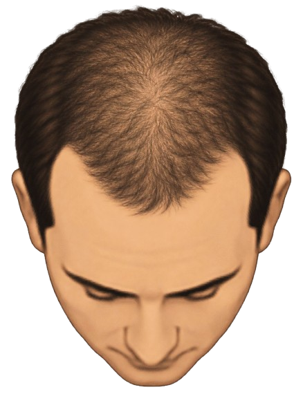 Overall thinning