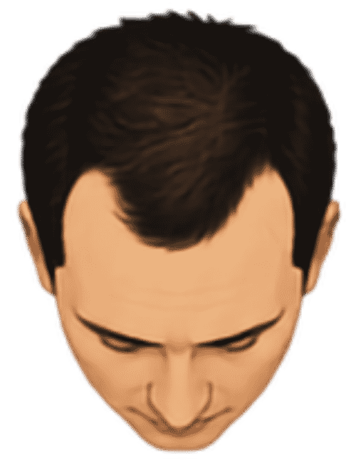 Hairline and temples