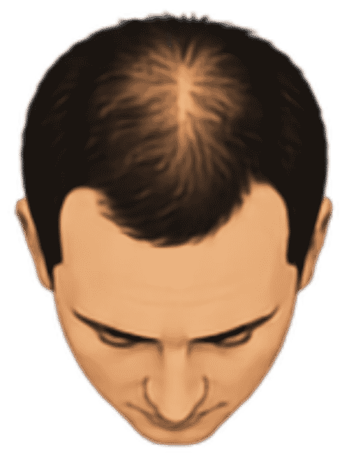 Hairline and crown
