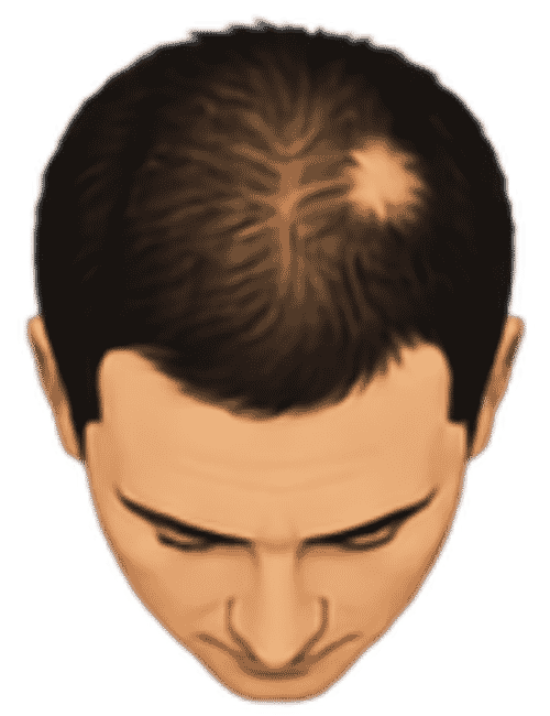 Patchy areas