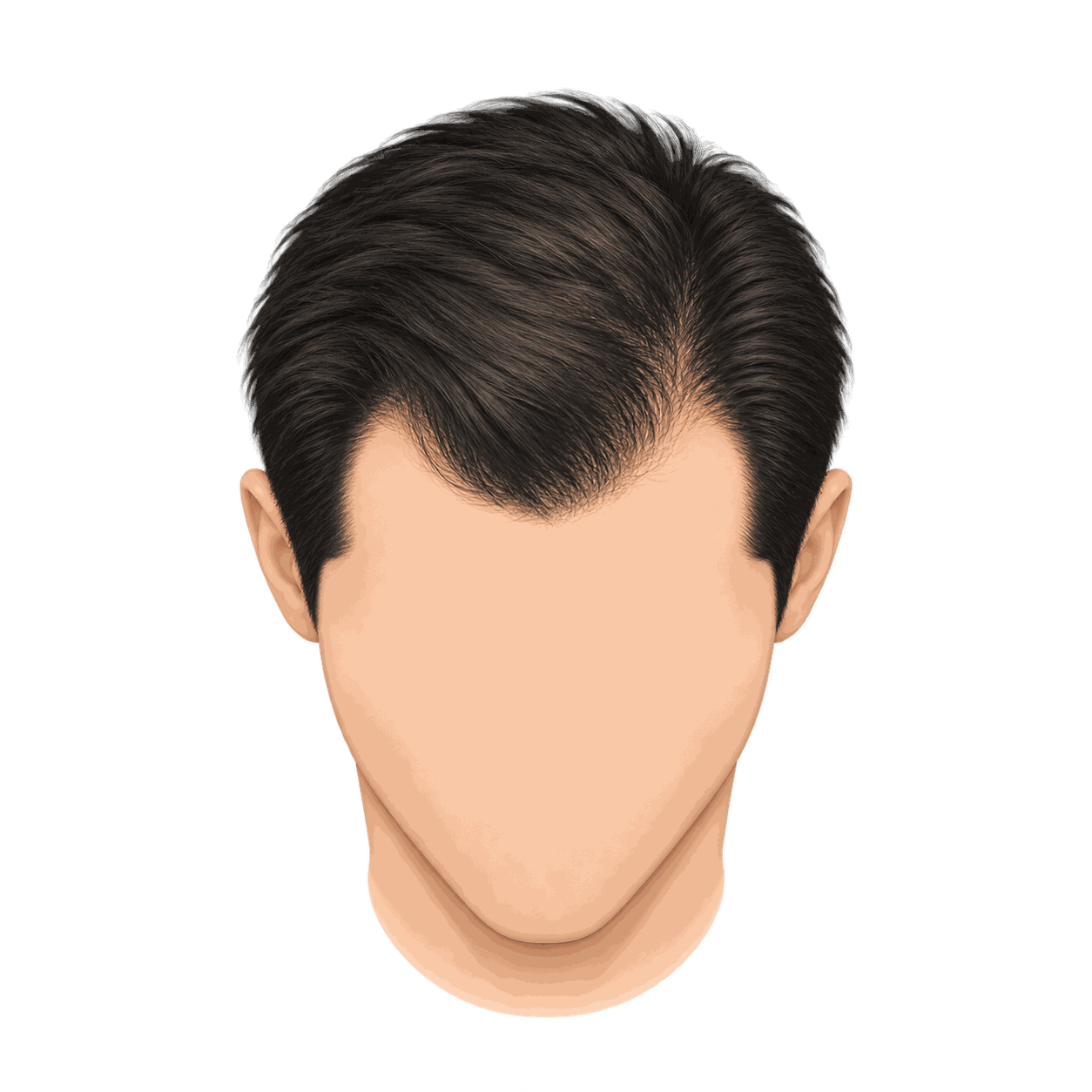Illustration showing mild early hair thinning
