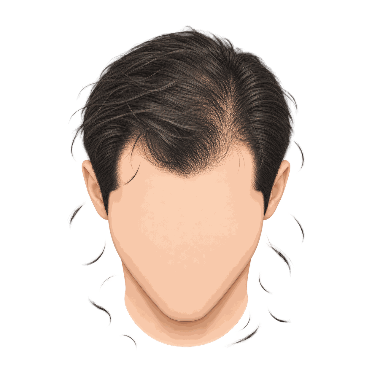 Illustration showing early hair shedding