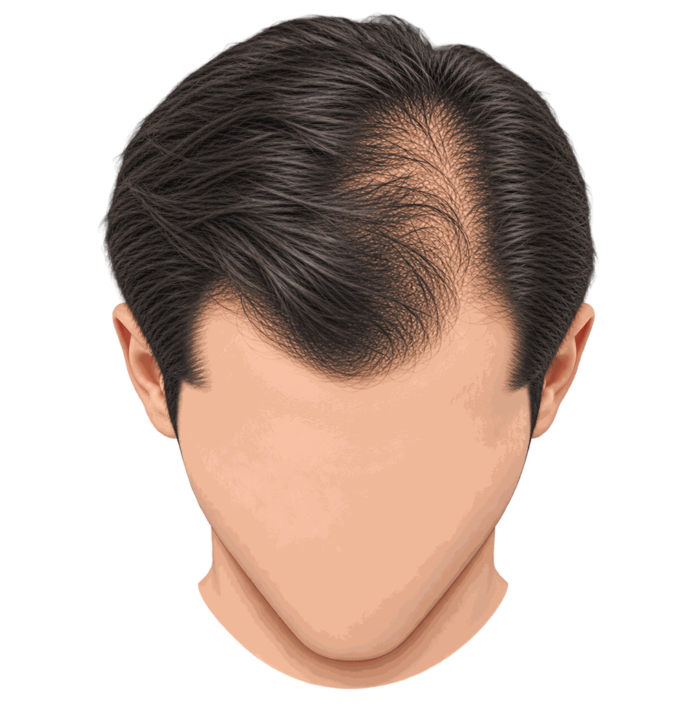 Illustration showing more visible scalp