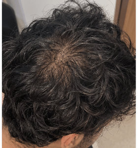 Illustrative crown view: before