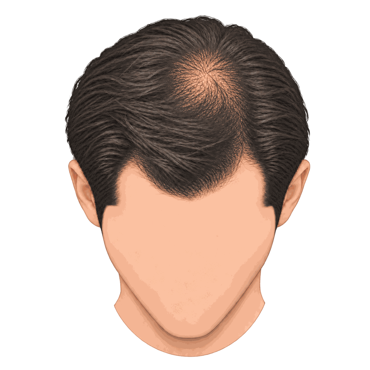 Illustration showing early crown thinning