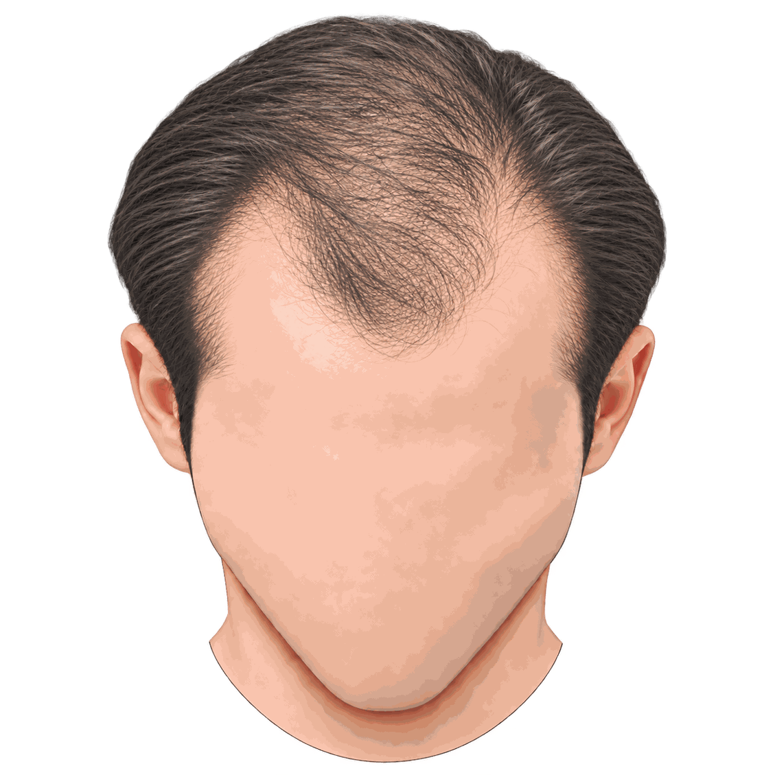 Illustration showing reduced hair density