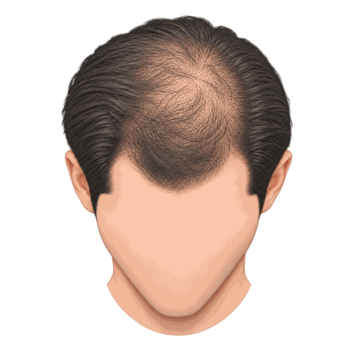 Illustration showing more noticeable crown thinning